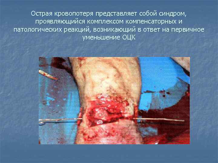 Острая кровопотеря представляет собой синдром, проявляющийся комплексом компенсаторных и патологических реакций, возникающий в ответ