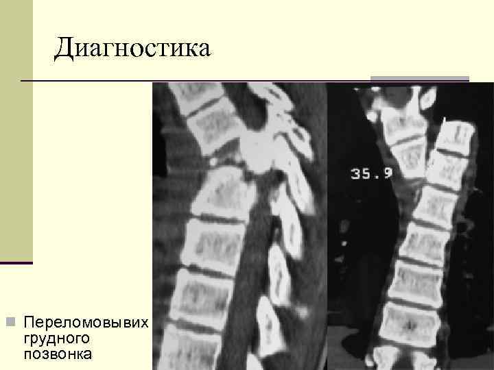 Диагностика n Переломовывих грудного позвонка 