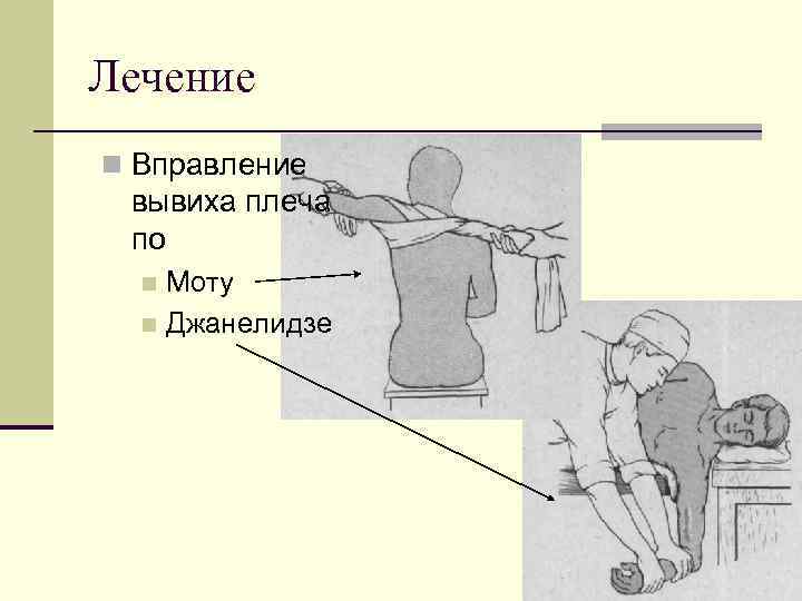 Вывих плеча мкб 10. Вправление вывиха по Мотту. Вправление вывиха плечевого сустава по Моту. Методы вправления вывихов. Метод вправления вывиха.