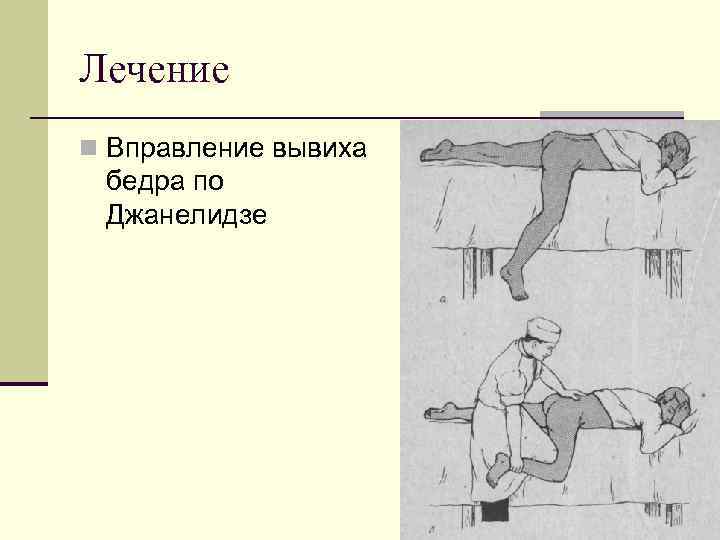 Лечение n Вправление вывиха бедра по Джанелидзе 