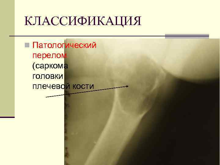 Патологический перелом. Саркома головки плечевой кости. Патологический перелом головки плечевой кости. Остеосаркома головки плечевой кости. Объемное образование верхней трети плечевой кости.