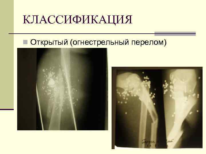 КЛАССИФИКАЦИЯ n Открытый (огнестрельный перелом) 