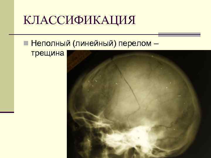 КЛАССИФИКАЦИЯ n Неполный (линейный) перелом – трещина 