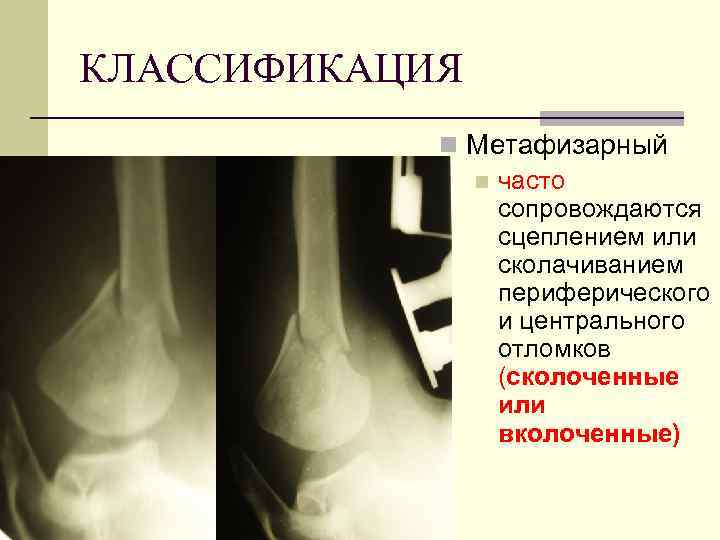 КЛАССИФИКАЦИЯ n Метафизарный n часто сопровождаются сцеплением или сколачиванием периферического и центрального отломков (сколоченные