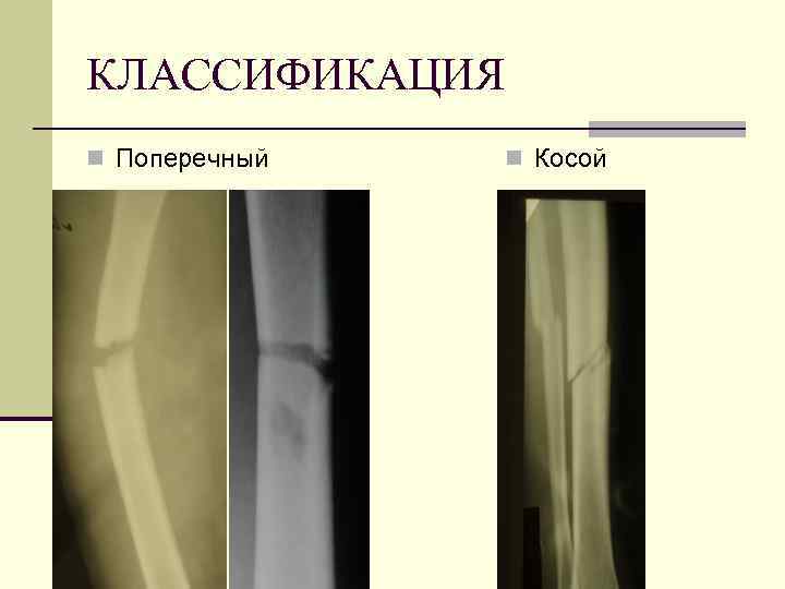 КЛАССИФИКАЦИЯ n Поперечный n Косой 