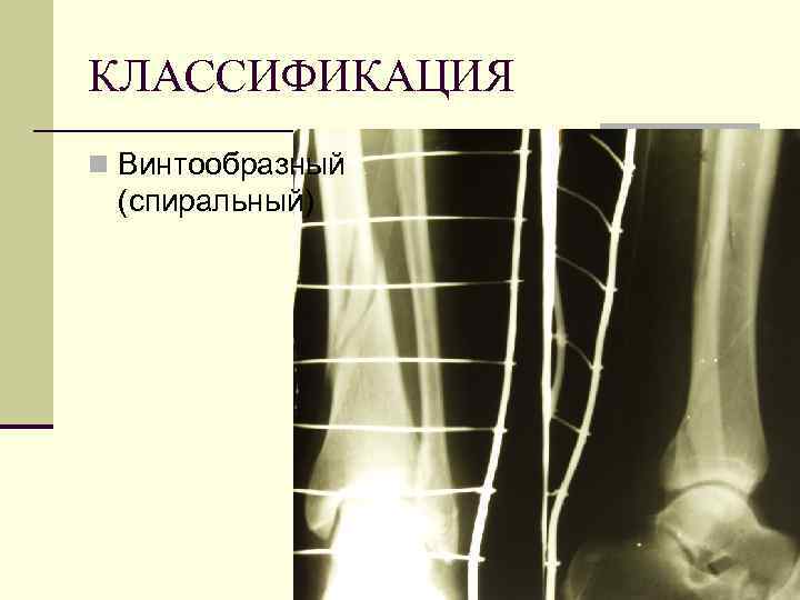 КЛАССИФИКАЦИЯ n Винтообразный (спиральный) 