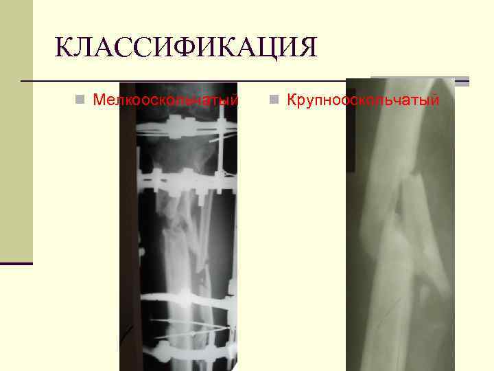 КЛАССИФИКАЦИЯ n Мелкооскольчатый n Крупнооскольчатый 
