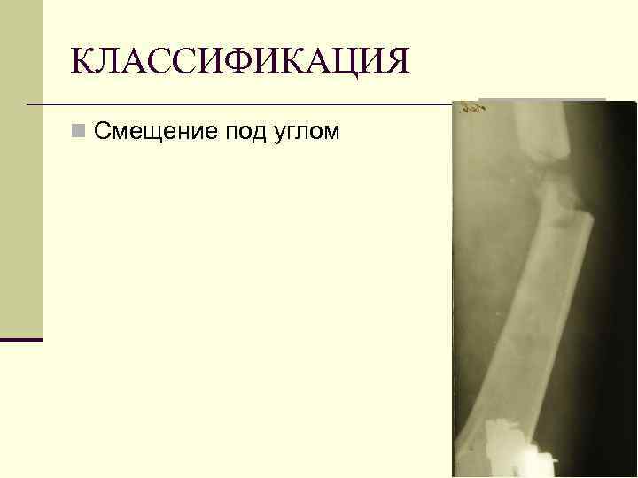 КЛАССИФИКАЦИЯ n Смещение под углом 