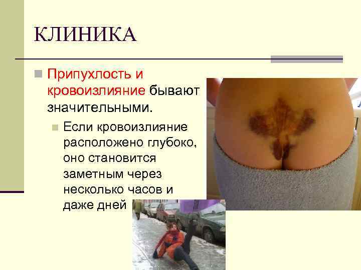 КЛИНИКА n Припухлость и кровоизлияние бывают значительными. n Если кровоизлияние расположено глубоко, оно становится