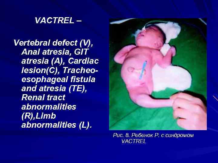 VACTREL – Vertebral defect (V), Anal atresia, GIT atresia (A), Cardiac lesion(C), Tracheoesophageal fistula