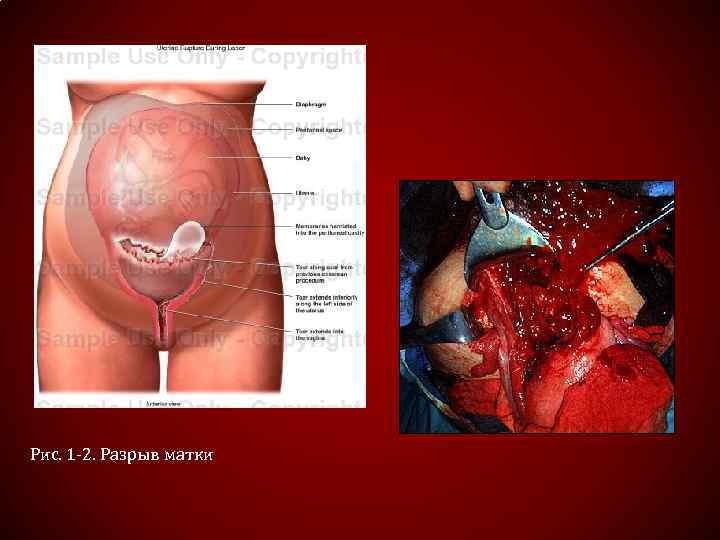 Рис. 1 -2. Разрыв матки 