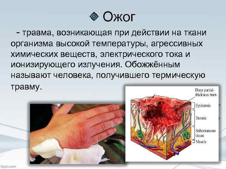 Ожог травма, возникающая при действии на ткани организма высокой температуры, агрессивных химических веществ, электрического