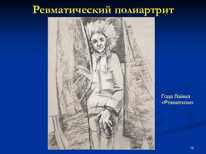 Ревматический полиартрит Года Лайма «Ревматизм» 15 