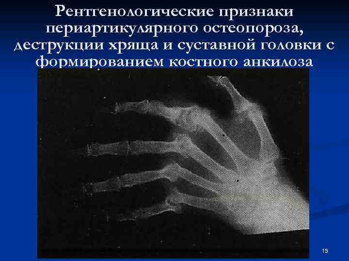Рентгенологические признаки периартикулярного остеопороза, деструкции хряща и суставной головки с формированием костного анкилоза 15