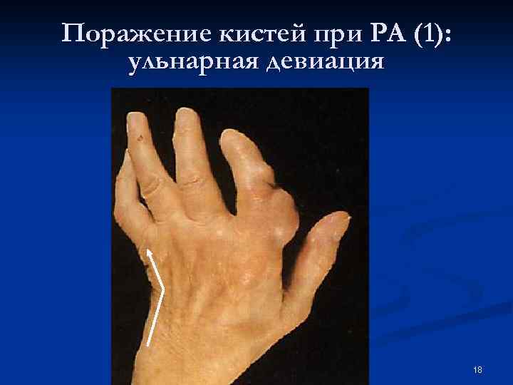 Поражение кистей при РА (1): ульнарная девиация 18 