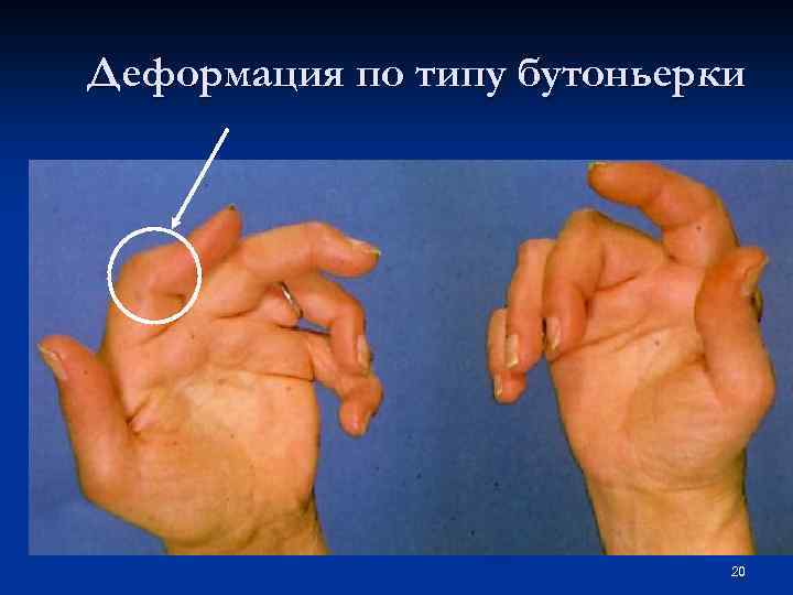 Деформация по типу бутоньерки 20 