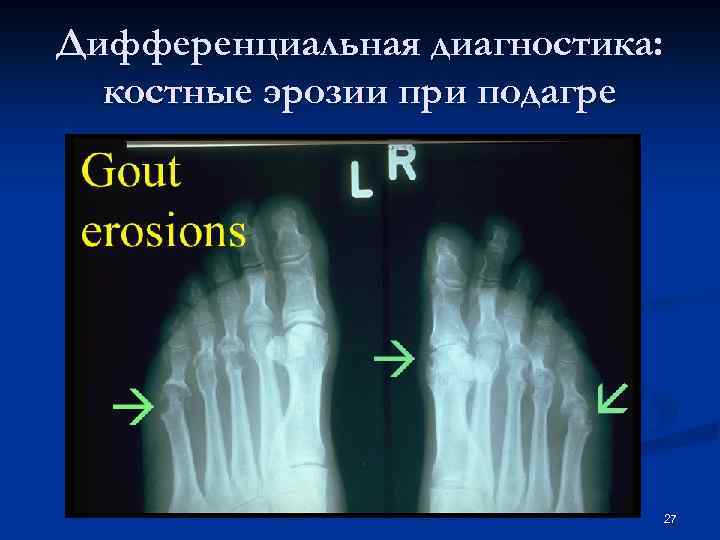 Дифференциальная диагностика: костные эрозии при подагре 27 