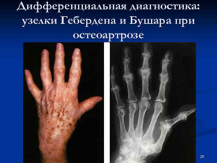 Дифференциальная диагностика: узелки Гебердена и Бушара при остеоартрозе 28 
