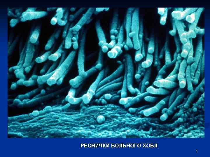 РЕСНИЧКИ БОЛЬНОГО ХОБЛ 7 