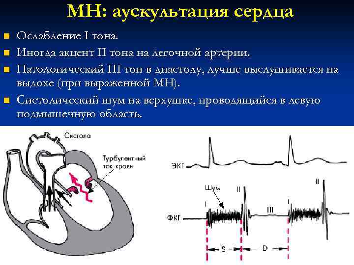 МН: аускультация сердца n n Ослабление I тона. Иногда акцент II тона на легочной