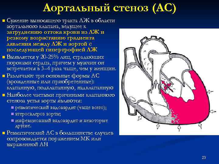 Умеренный фиброз аортального клапана