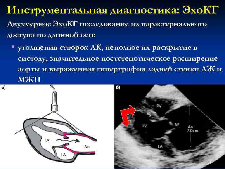 Инструментальная диагностика: Эхо. КГ Двухмерное Эхо. КГ исследование из парастернального доступа по длинной оси: