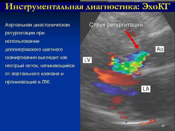 Митральная регургитация 1 степени что это