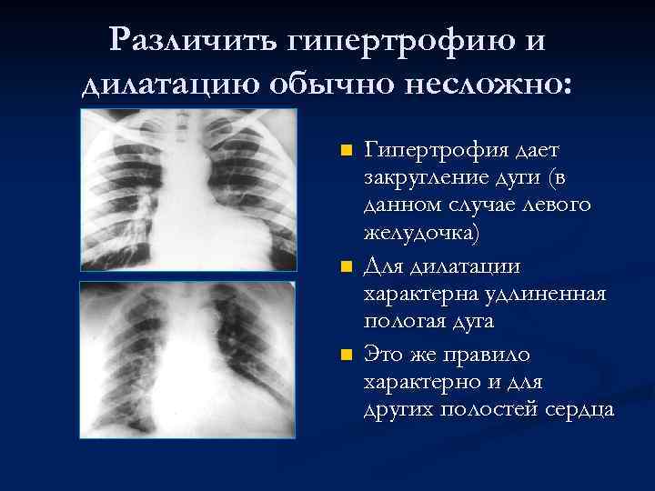Различить гипертрофию и дилатацию обычно несложно: n n n Гипертрофия дает закругление дуги (в