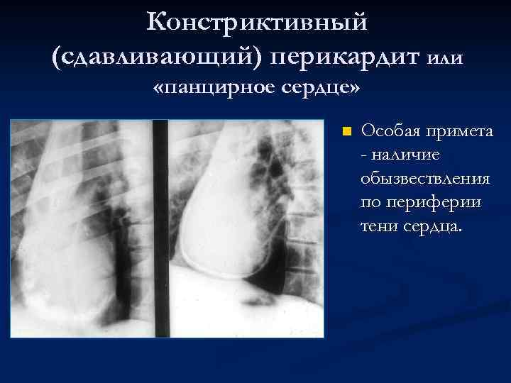 Констриктивный (сдавливающий) перикардит или «панцирное сердце» n Особая примета - наличие обызвествления по периферии