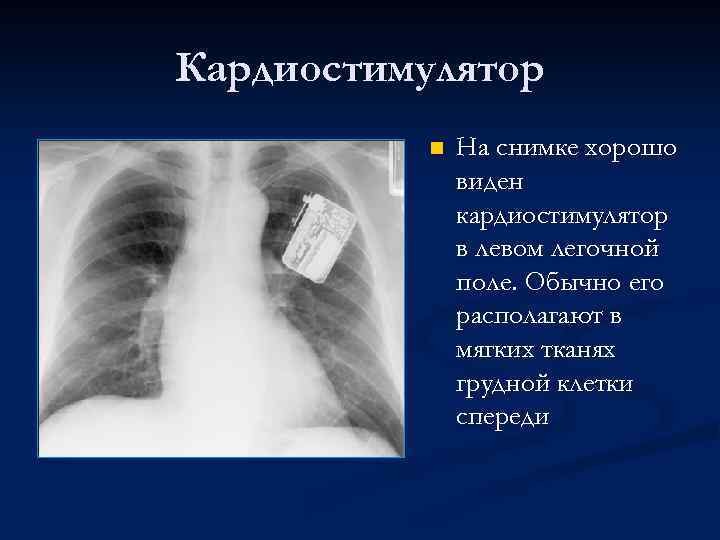 Кардиостимулятор n На снимке хорошо виден кардиостимулятор в левом легочной поле. Обычно его располагают