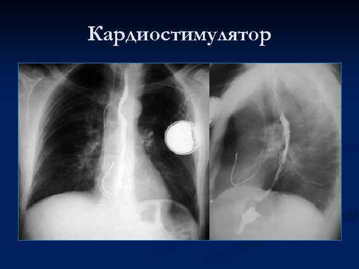 Кардиостимулятор 