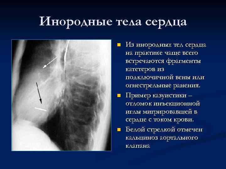 Инородные тела сердца n n n Из инородных тел сердца на практике чаще всего