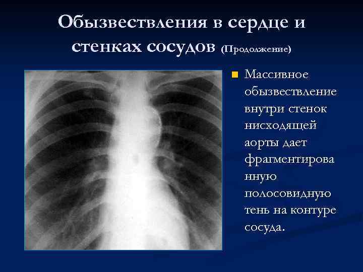 Обызвествления в сердце и стенках сосудов (Продолжение) n Массивное обызвествление внутри стенок нисходящей аорты