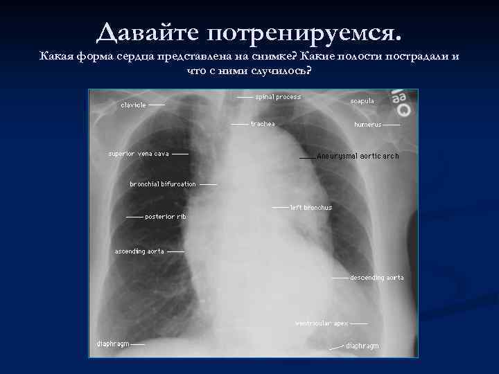 Давайте потренируемся. Какая форма сердца представлена на снимке? Какие полости пострадали и что с