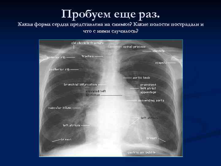 Пробуем еще раз. Какая форма сердца представлена на снимке? Какие полости пострадали и что