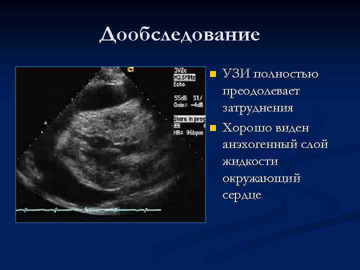 Дообследование n n УЗИ полностью преодолевает затруднения Хорошо виден анэхогенный слой жидкости окружающий сердце