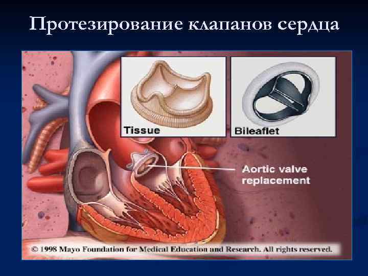 Протезирование клапанов сердца 