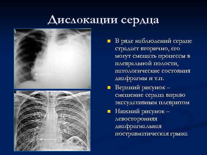 Дислокации сердца n n n В ряде наблюдений сердце страдает вторично, его могут смещать