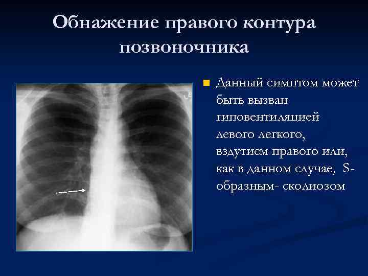 Обнажение правого контура позвоночника n Данный симптом может быть вызван гиповентиляцией левого легкого, вздутием