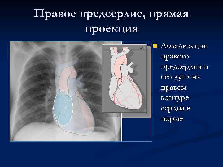 Правое предсердие, прямая проекция n Локализация правого предсердия и его дуги на правом контуре