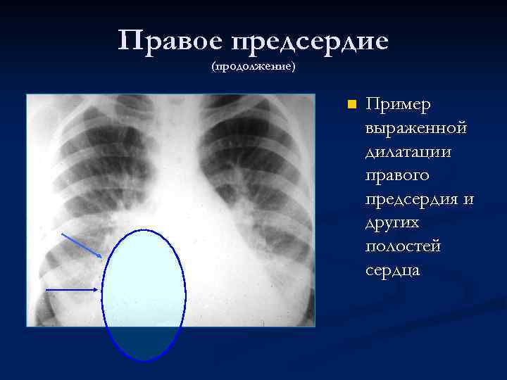 Правое предсердие (продолжение) n Пример выраженной дилатации правого предсердия и других полостей сердца 