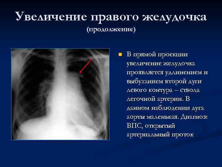 Увеличение правого желудочка (продолжение) n В прямой проекции увеличение желудочка проявляется удлинением и выбуханием