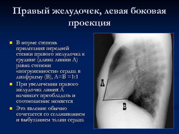 Правый желудочек, левая боковая проекция n n n В норме степень прилегания передней стенки