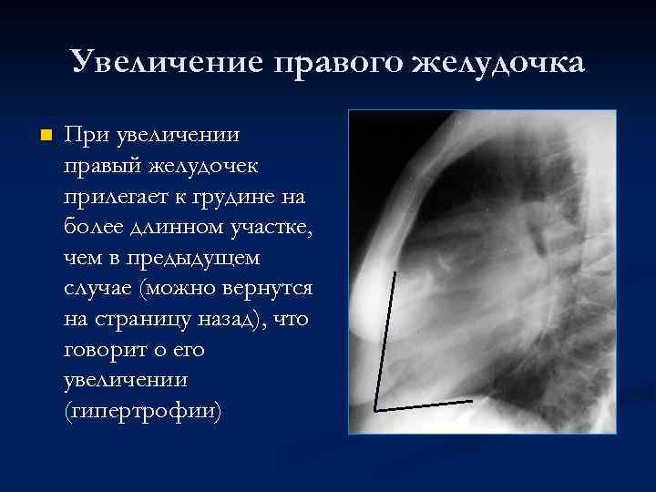 Увеличение правого желудочка n При увеличении правый желудочек прилегает к грудине на более длинном