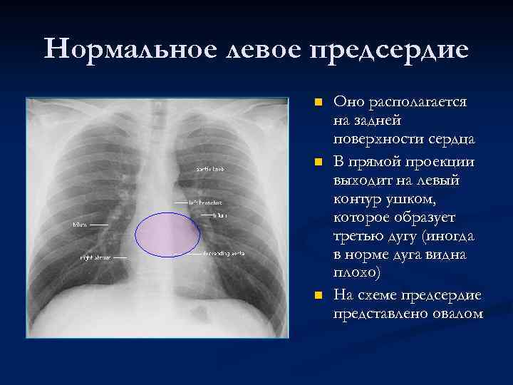 Нормальное левое предсердие n n n Оно располагается на задней поверхности сердца В прямой