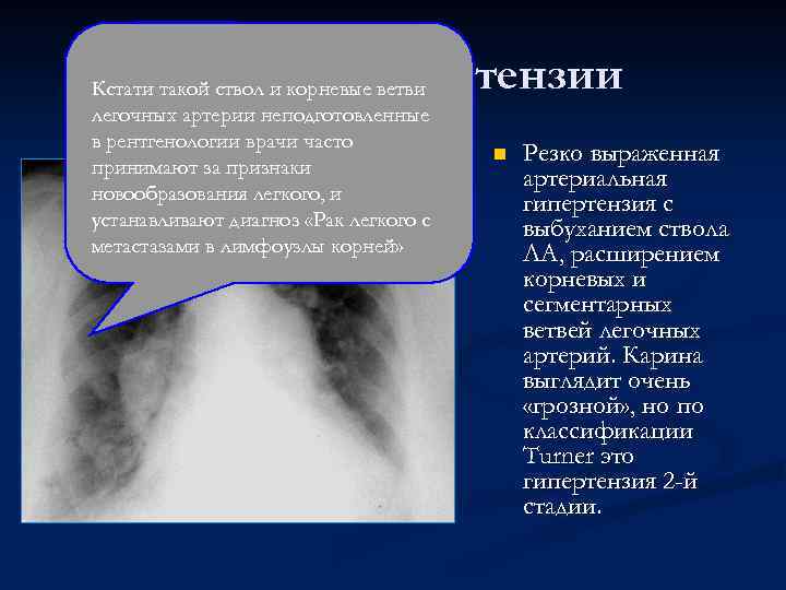Пример гипертензии Кстати такой ствол и корневые ветви легочных артерии неподготовленные в рентгенологии врачи