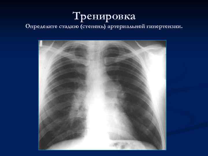 Тренировка Определите стадию (степень) артериальной гипертензии. 