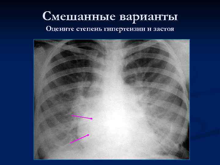 Смешанные варианты Оцените степень гипертензии и застоя 