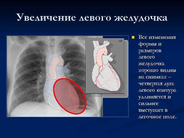 Увеличение левого желудочка n Все изменения формы и размеров левого желудочка хорошо видны на