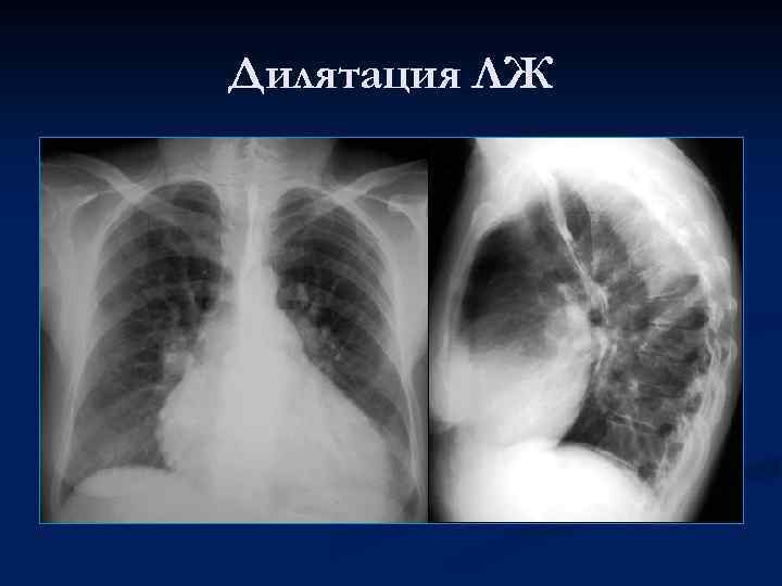 Дилятация ЛЖ 